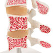 Bild på Ryggkotor med osteoporosis snitt A78 1000153
