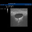 Bild på Ultraljudsmodell - Bröst med cystor 1019634